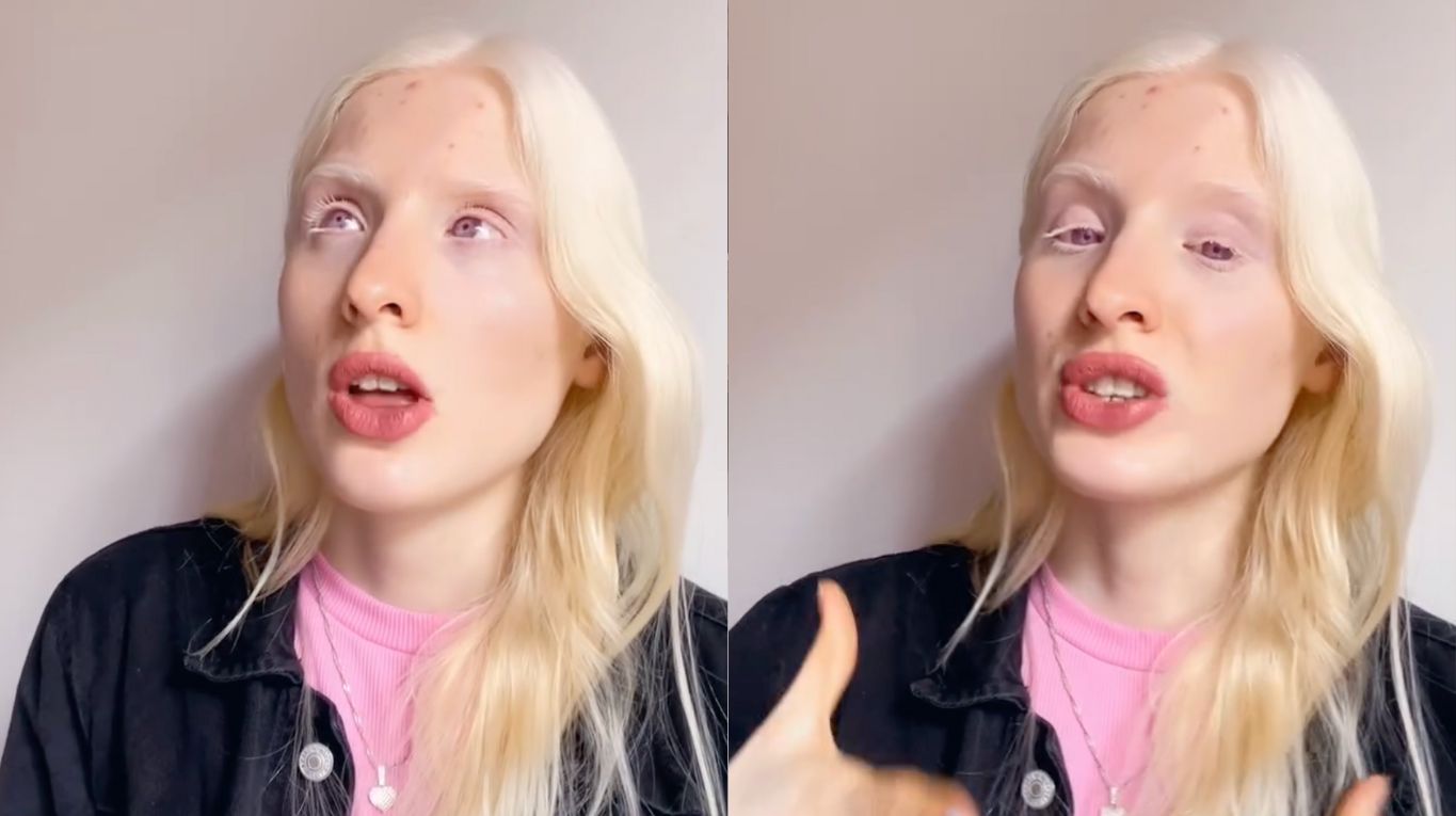 Modelo con albinismo responde preguntas frecuentes en un video viral que educa y genera empatía